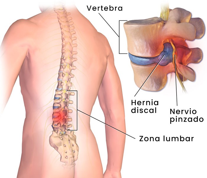 Hernia discal lumbar